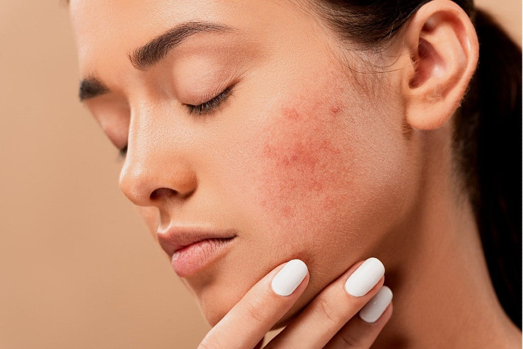 Get Rid of Facial Redness with Skin-Friendly Serums
