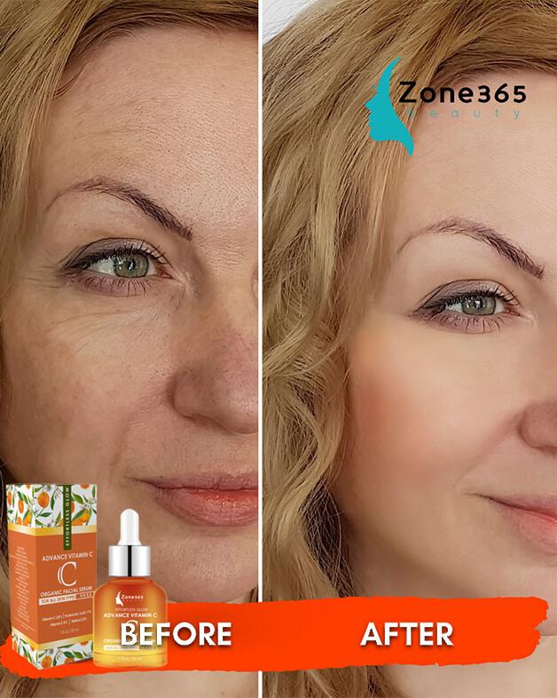 Vitamin C Serum Before and After Pictures